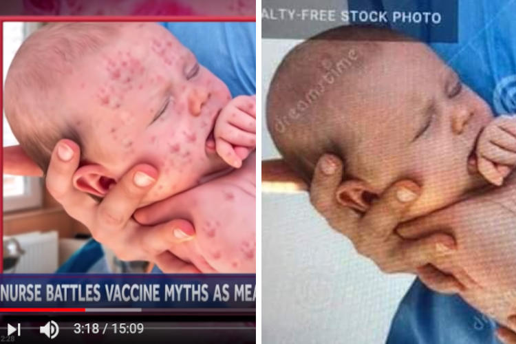 Fake news measles CNN and NBC Caught Faking Photo of Baby with Measles